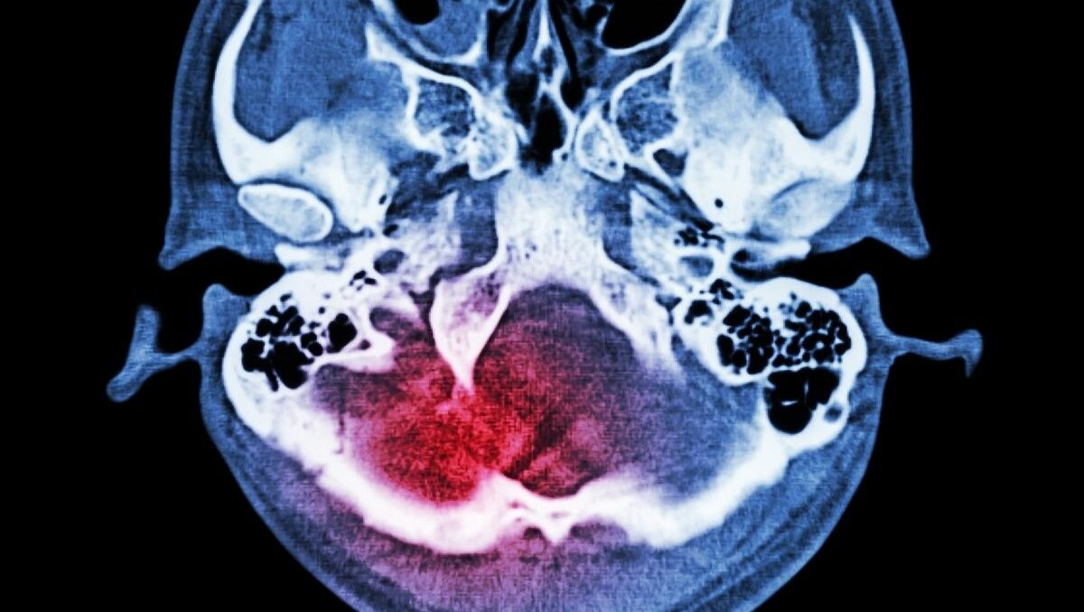 Scan of a brain injury