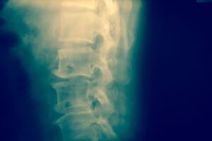 X-Ray of a person's spinal cord
