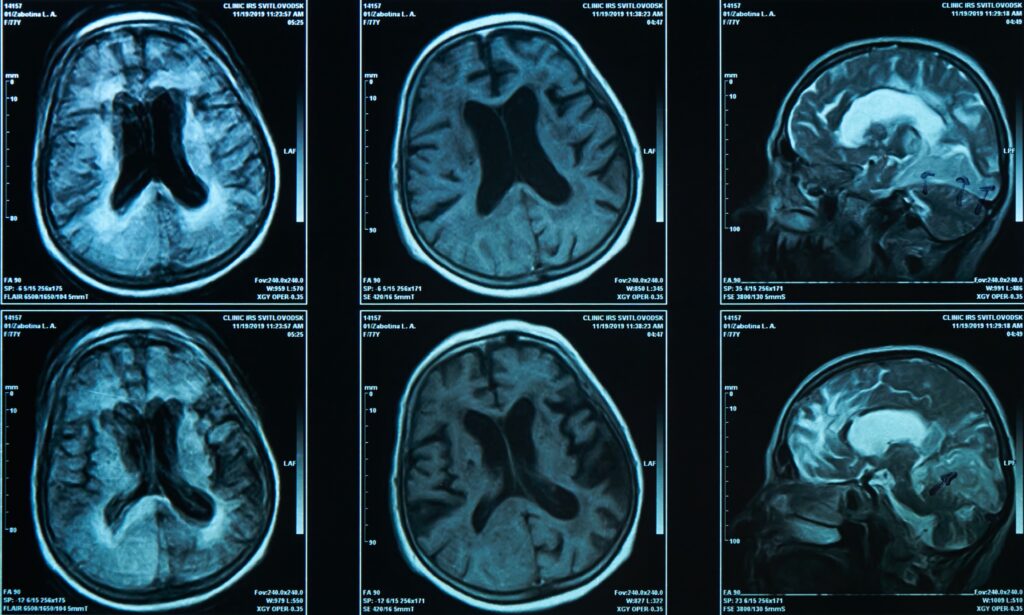 Brain Injuries