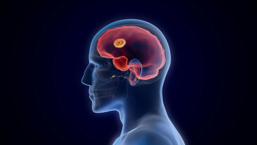 3D medical illustration showing the human brain with highlighted injury area, representing the effects of traumatic brain injury.